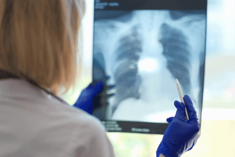 Lung Thickening (Pulmonary Fibrosis)