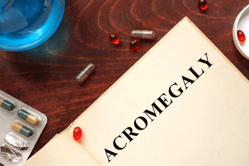 Acromegaly (Pituitary Gland Disorder)