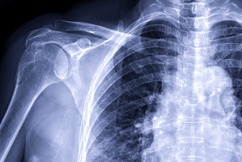 Gorham-Stout Disease