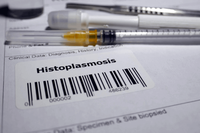 Histoplazmozis