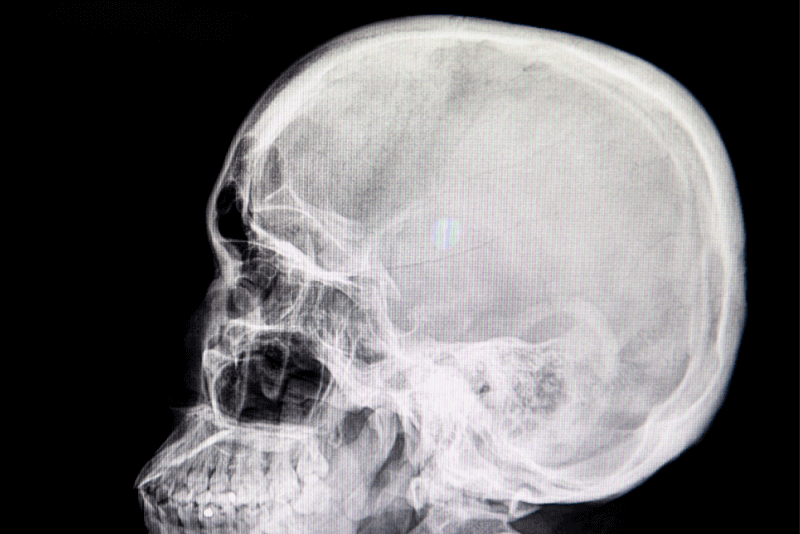 Skull Fracture