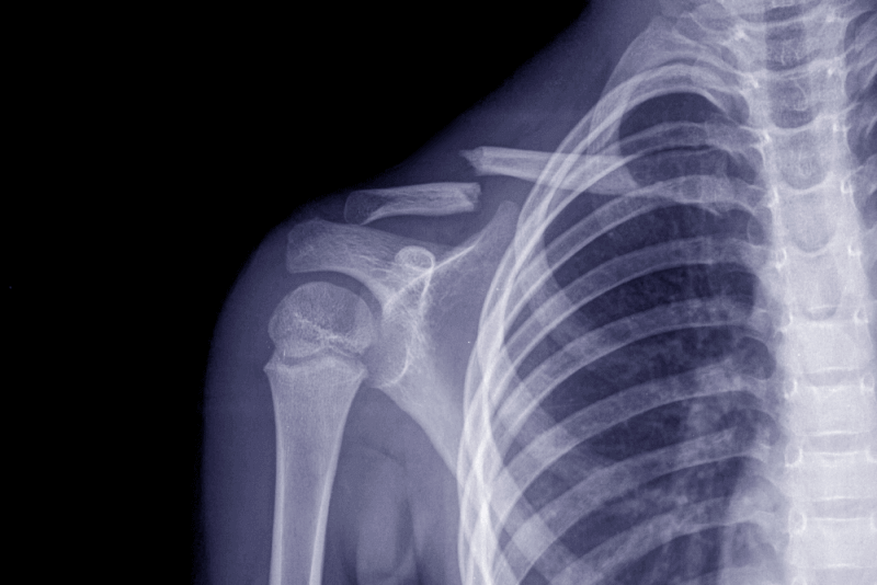 Clavicle Fracture