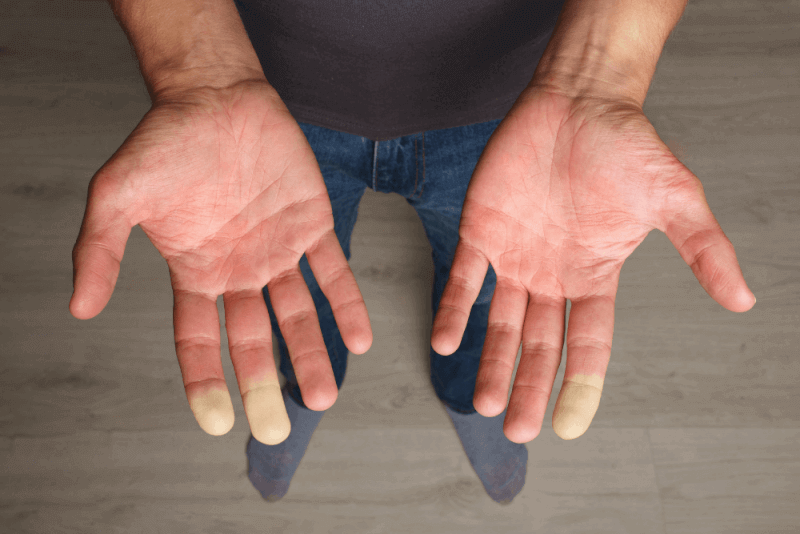 Raynaud Sendromu