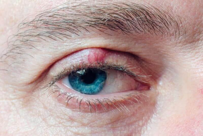 Chalazion (Eyelid Cyst)